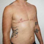 Chest Masculinization Surgery Before & After Patient #2122