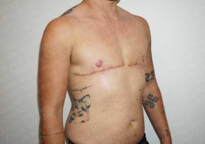 Chest Masculinization Surgery Before & After Patient #2122