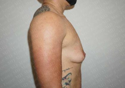 Chest Masculinization Surgery Before & After Patient #2122