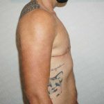 Chest Masculinization Surgery Before & After Patient #2122