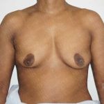 Chest Masculinization Surgery Before & After Patient #2121