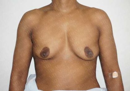 Chest Masculinization Surgery Before & After Patient #2121