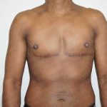 Chest Masculinization Surgery Before & After Patient #2121