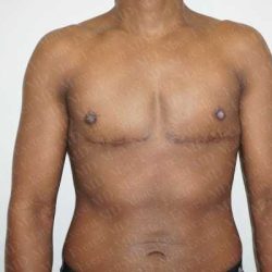 Chest Masculinization Surgery Before & After Patient #2121