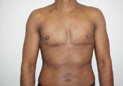 Chest Masculinization Surgery Before & After Patient #2121