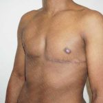 Chest Masculinization Surgery Before & After Patient #2121