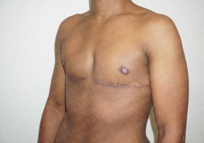 Chest Masculinization Surgery Before & After Patient #2121