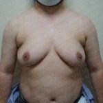 Chest Masculinization Surgery Before & After Patient #2120