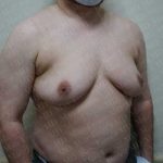 Chest Masculinization Surgery Before & After Patient #2120