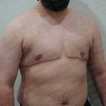 Chest Masculinization Surgery Before & After Patient #2120