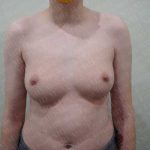 Chest Masculinization Surgery Before & After Patient #2119