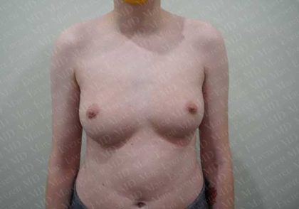 Chest Masculinization Surgery Before & After Patient #2119