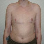 Chest Masculinization Surgery Before & After Patient #2119