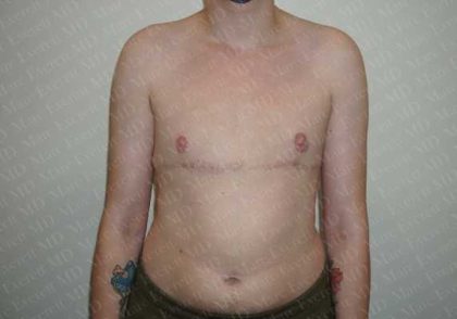 Chest Masculinization Surgery Before & After Patient #2119