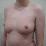 Chest Masculinization Surgery Before & After Patient #2119