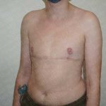 Chest Masculinization Surgery Before & After Patient #2119