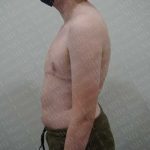 Chest Masculinization Surgery Before & After Patient #2119