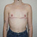 Chest Masculinization Surgery Before & After Patient #2118
