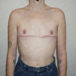 Chest Masculinization Surgery Before & After Patient #2118