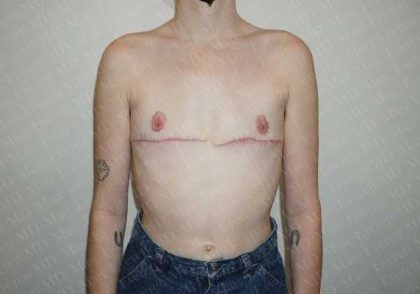 Chest Masculinization Surgery Before & After Patient #2118