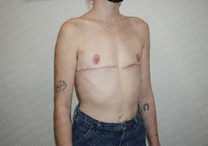 Chest Masculinization Surgery Before & After Patient #2118