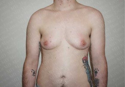 Chest Masculinization Surgery Before & After Patient #2117