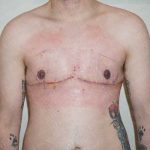 Chest Masculinization Surgery Before & After Patient #2117