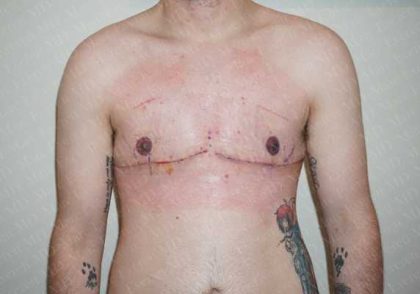 Chest Masculinization Surgery Before & After Patient #2117