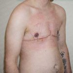 Chest Masculinization Surgery Before & After Patient #2117