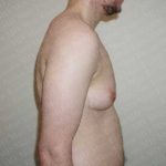 Chest Masculinization Surgery Before & After Patient #2117