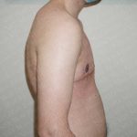 Chest Masculinization Surgery Before & After Patient #2117