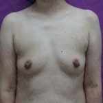 Nipple Procedures Before & After Patient #2093