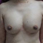 Nipple Procedures Before & After Patient #2093