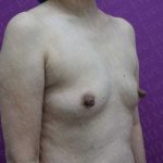 Nipple Procedures Before & After Patient #2093