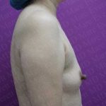 Nipple Procedures Before & After Patient #2093