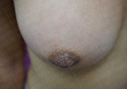 Nipple Procedures Before & After Patient #2092