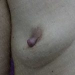Nipple Procedures Before & After Patient #2091