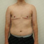 Chest Masculinization Surgery Before & After Patient #2536