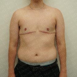 Chest Masculinization Surgery Before & After Patient #2536