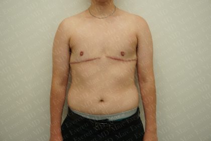 Chest Masculinization Surgery Before & After Patient #2536