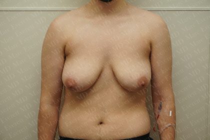 Chest Masculinization Surgery Before & After Patient #2536