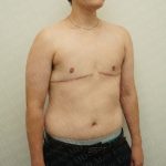 Chest Masculinization Surgery Before & After Patient #2536