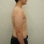 Chest Masculinization Surgery Before & After Patient #2536