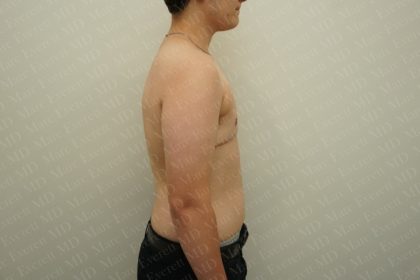 Chest Masculinization Surgery Before & After Patient #2536
