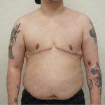 Chest Masculinization Surgery Before & After Patient #2556