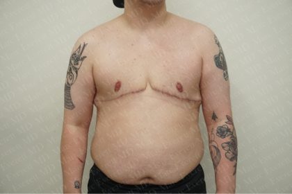 Chest Masculinization Surgery Before & After Patient #2556