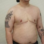 Chest Masculinization Surgery Before & After Patient #2556