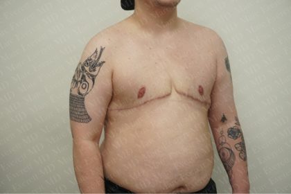 Chest Masculinization Surgery Before & After Patient #2556