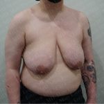 Chest Masculinization Surgery Before & After Patient #2556