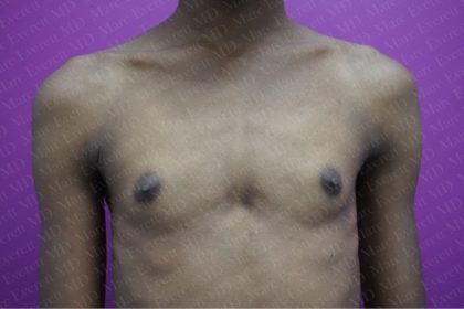 Gender Affirming Breast Augmentation Before & After Patient #2563